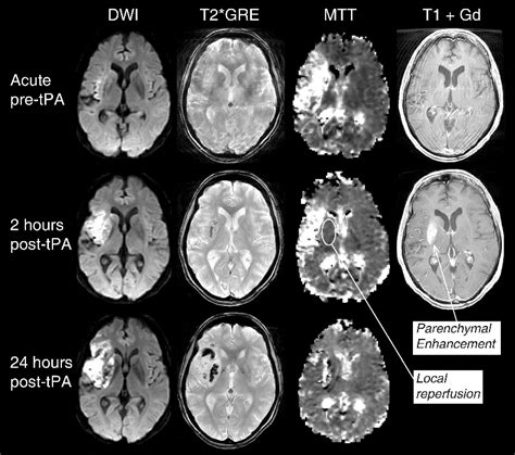 [PDF] MRI Detection of Early Blood-Brain Barrier Disruption ...