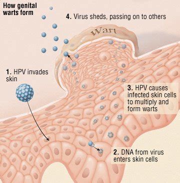 Genital Warts Guide: Causes, Symptoms and Treatment Options