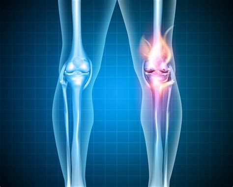 Knee Surgery Recovery - Orthopedic Patient Healing | Orthopaedic ...