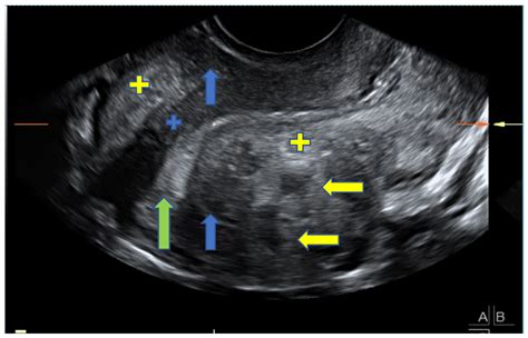 Adenomyosis Ultrasound