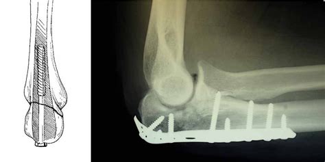 Olecranon Fracture Classification