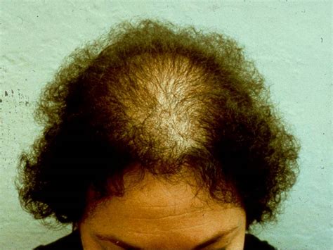 HEALTH FROM TRUSTED SOURCES: Hair loss / Alopecia