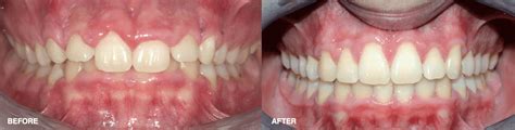 What is the difference between gingivectomy and gingivoplasty? | News ...