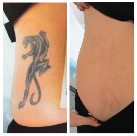 7 best Dermabrasion Tattoo Removal images on Pinterest | Laser tattoo ...