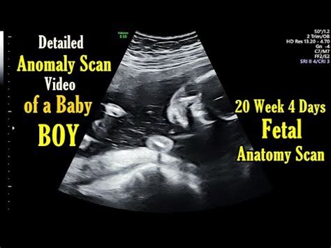 20 Week Ultrasound - Baby Boy! | Doovi