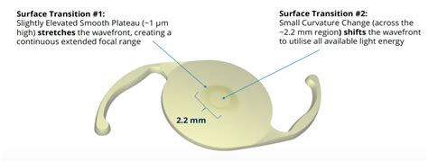 Alcon Vivity Lens implant - Tanner Eyes