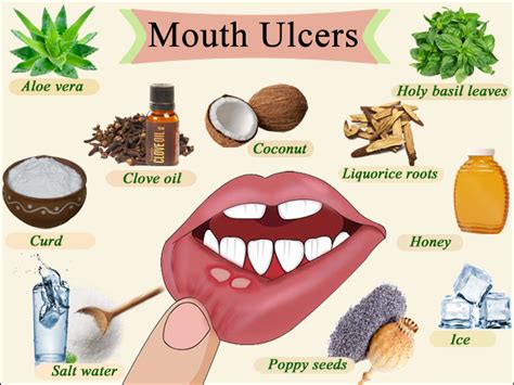 Natural Remedies For Mouth Ulcers | Dental Galaxy