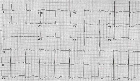 Hypokalemia Ecg Strip