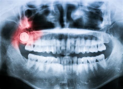 We finally know why wisdom teeth emerge so late | Popular Science