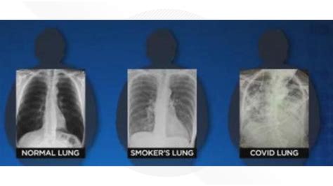 Post-COVID lungs worse than the worst smokers' lungs, surgeon say ...