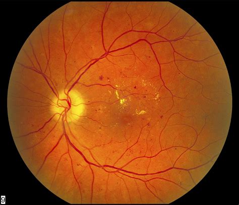 Diabetic Retinopathy: An Update on Treatment - The American Journal of ...