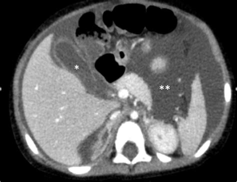 Figure 1 from Gallbladder perforation following trauma in an 18-month ...