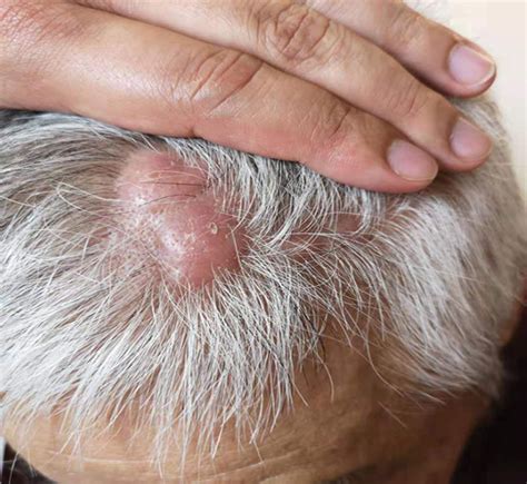 Agminated Nodules on the Scalp | MDedge Dermatology