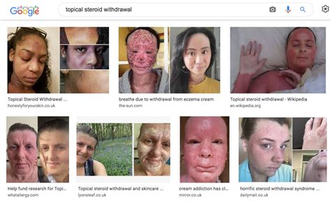 Side Effects of Topical Steroids | TSW Assist