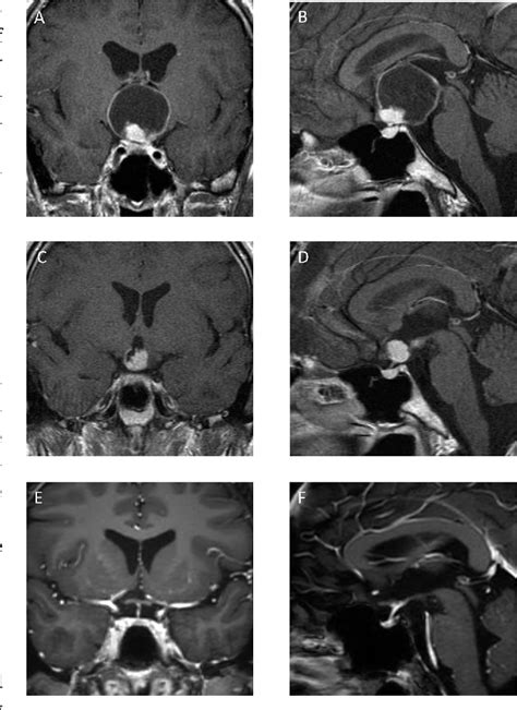 Figure 3 from Surgical aspects in craniopharyngioma treatment ...