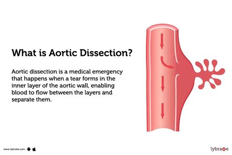 Aortic Dissection: Causes, Symptoms, Treatment and Cost