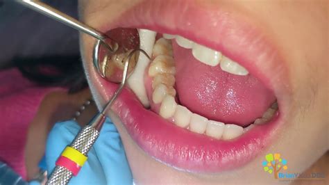 Molar Cavity Filling with Composite - Dental Clinic