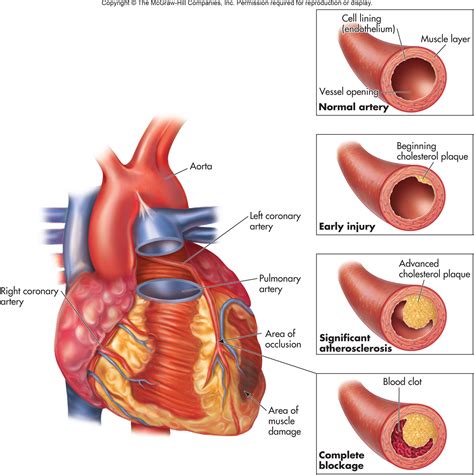 Aortoiliac Atherosclerosis | Atherosclerosis | Pinterest