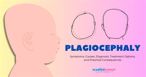 Understanding Plagiocephaly: Symptoms, Causes, Diagnosis, Treatment ...