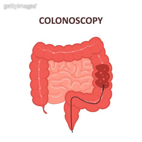 Colonoscopy procedure. Intestine exam and treatment. Colon polypectomy ...