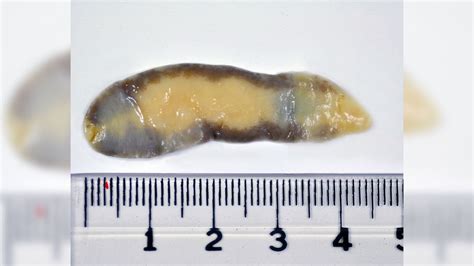 What Do Roundworms Look Like In Human Stool - Infoupdate.org