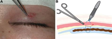 Treatment of Suture-related Complications of Buried-suture D ...