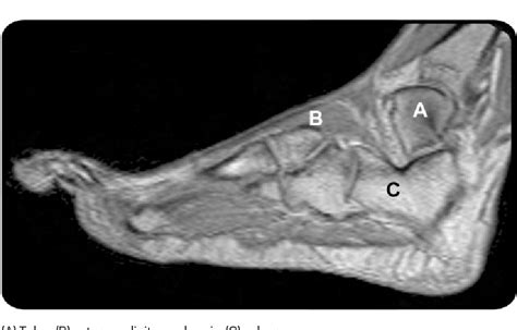 Foot Muscles Mri / Foot anatomy mri coronal Images / Its main symptoms ...