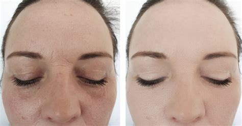 woman wrinkles face before and after procedures - Toronto Med Spa