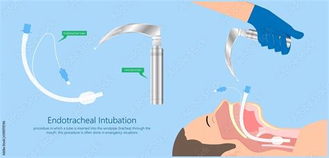 Endotracheal intubation ICU care unit COVID 19 larynx throat rescue ...