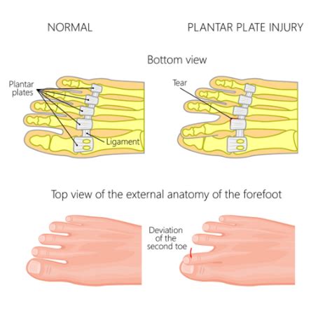 Plantar Plate Injury - Knowing the Symptoms and How to Treat It