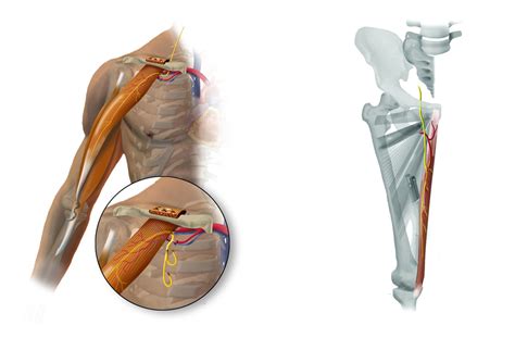 Gracilis Functional Free Muscle Transfer following Brachial Plexus ...