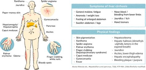 Pictures Of Cirrhosis Of The Liver Symptoms - the meta pictures