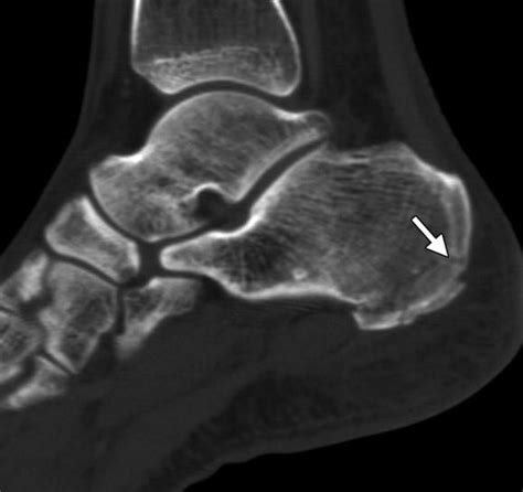 Multidetector CT Evaluation of Calcaneal Fractures | RadioGraphics