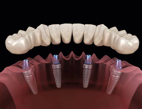 The Different Types of Dental Implants Available - Fabrioberto.com