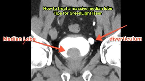 Tips for managing a large prostate median lobe- How to GreenLight laser ...