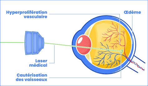 Traitement laser rétinopathie diabétique & œdème maculaire diabétique