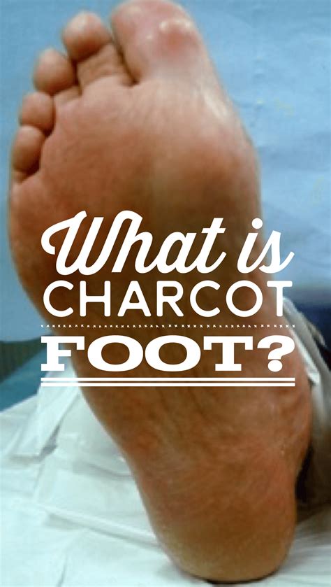 What is Charcot foot? | Diabetic wounds, Neuropathy, Diabeties