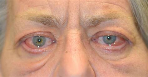 Thyroid Eye Disesase, patient information