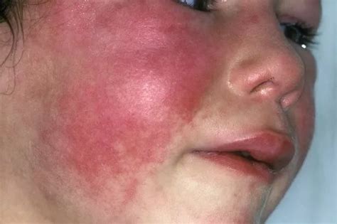 Know the symptoms of scarlet fever and mumps as cases reported in ...