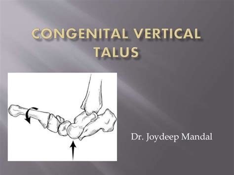 Congenital vertical talus