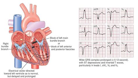 Left bundle branch block. | Life Support Module | Pinterest | Heart ...