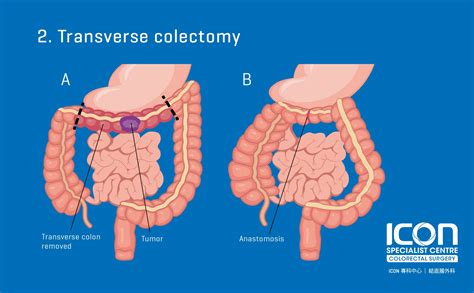 Colorectal resection (colectomy) — Icon Specialist Centre