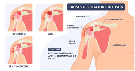 Rotator Cuff Injury & Treatment Options | Advanced Surgery Center