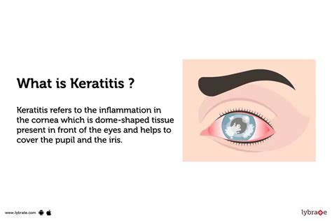 Keratitis: Treatment, Procedure, Cost, Recovery, Side Effects And More