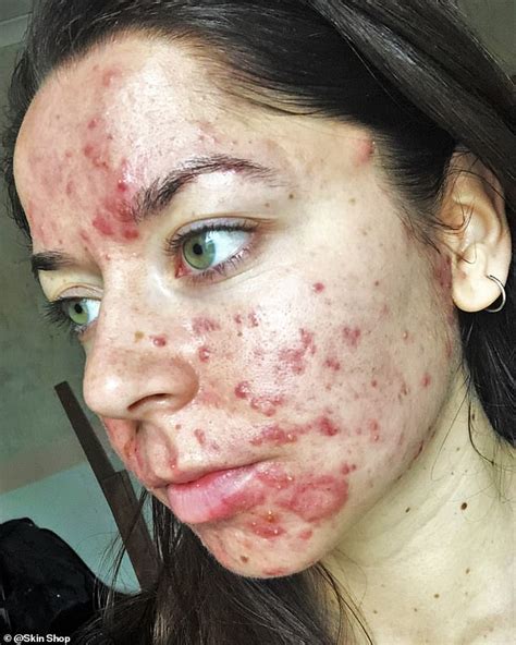 Woman who was bullied at school due to severe acne has seen ...