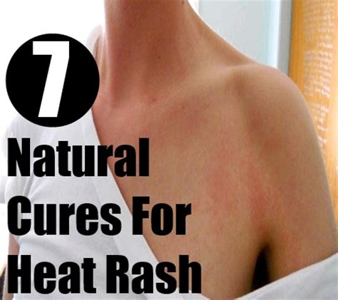 7 Natural Cures For Heat Rash - How To Cure Heat Rash Naturally ...