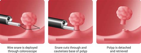 How Long Do You Bleed After Cervical Polyp Removal | Renew Physical Therapy