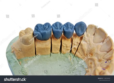 830 Dental wax up Images, Stock Photos & Vectors | Shutterstock