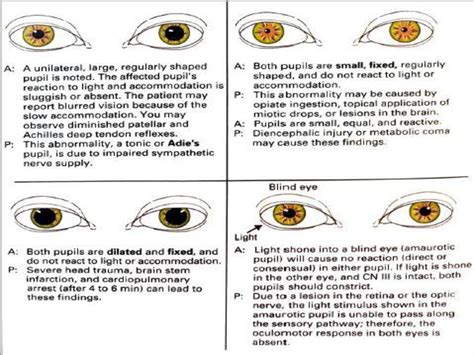 Hippus Pupil Reaction