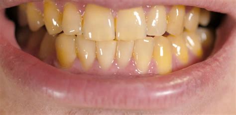 What Causes Yellow Teeth? - Dr. Miski